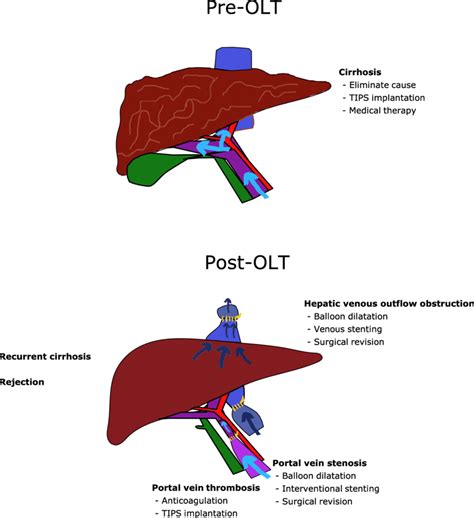 what is pht|PHT .